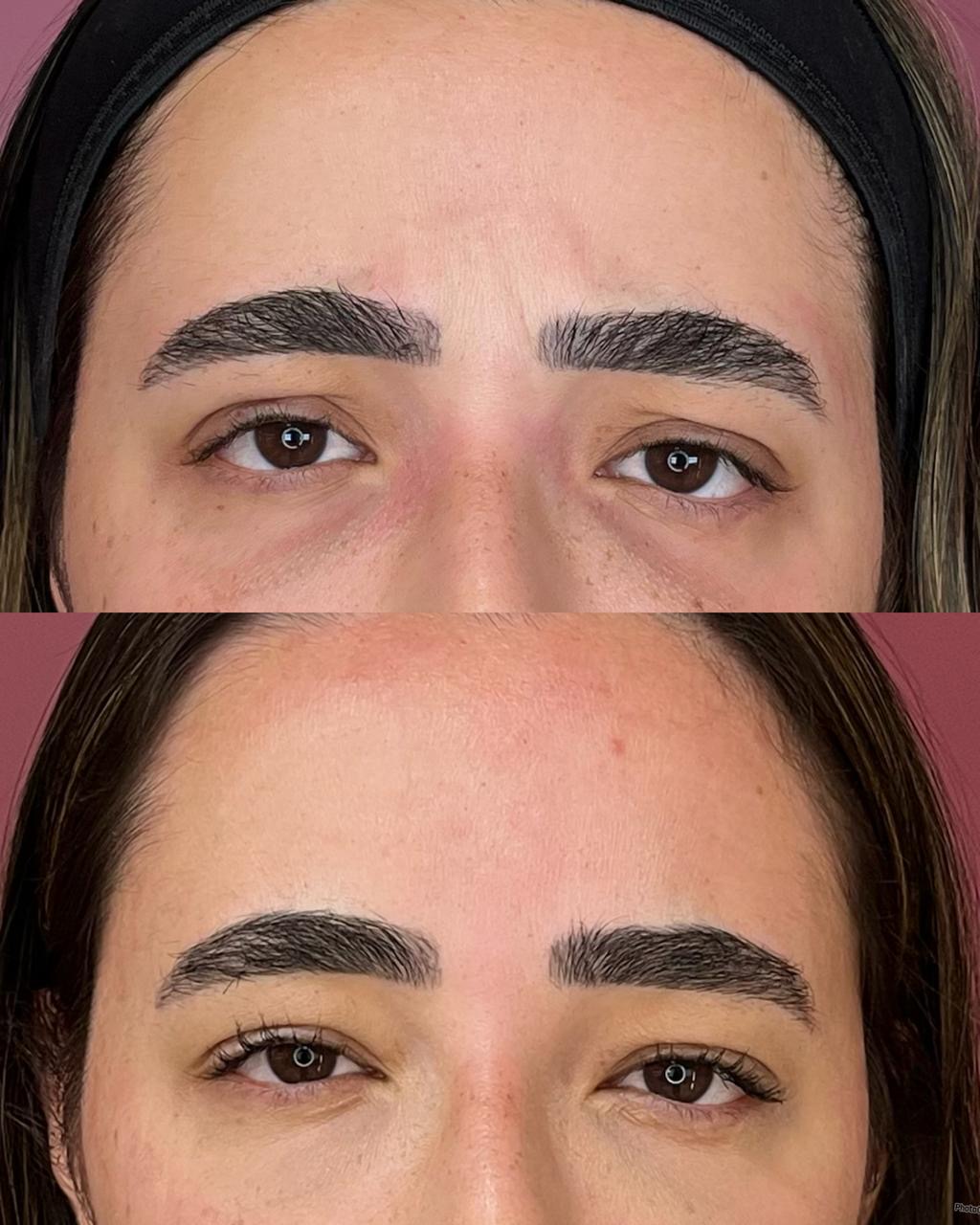 Harmonização facial