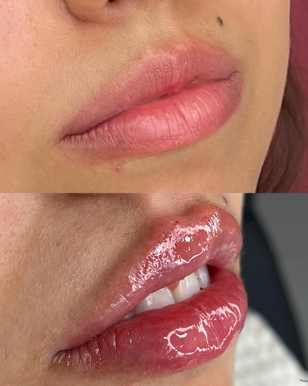 Harmonização facial