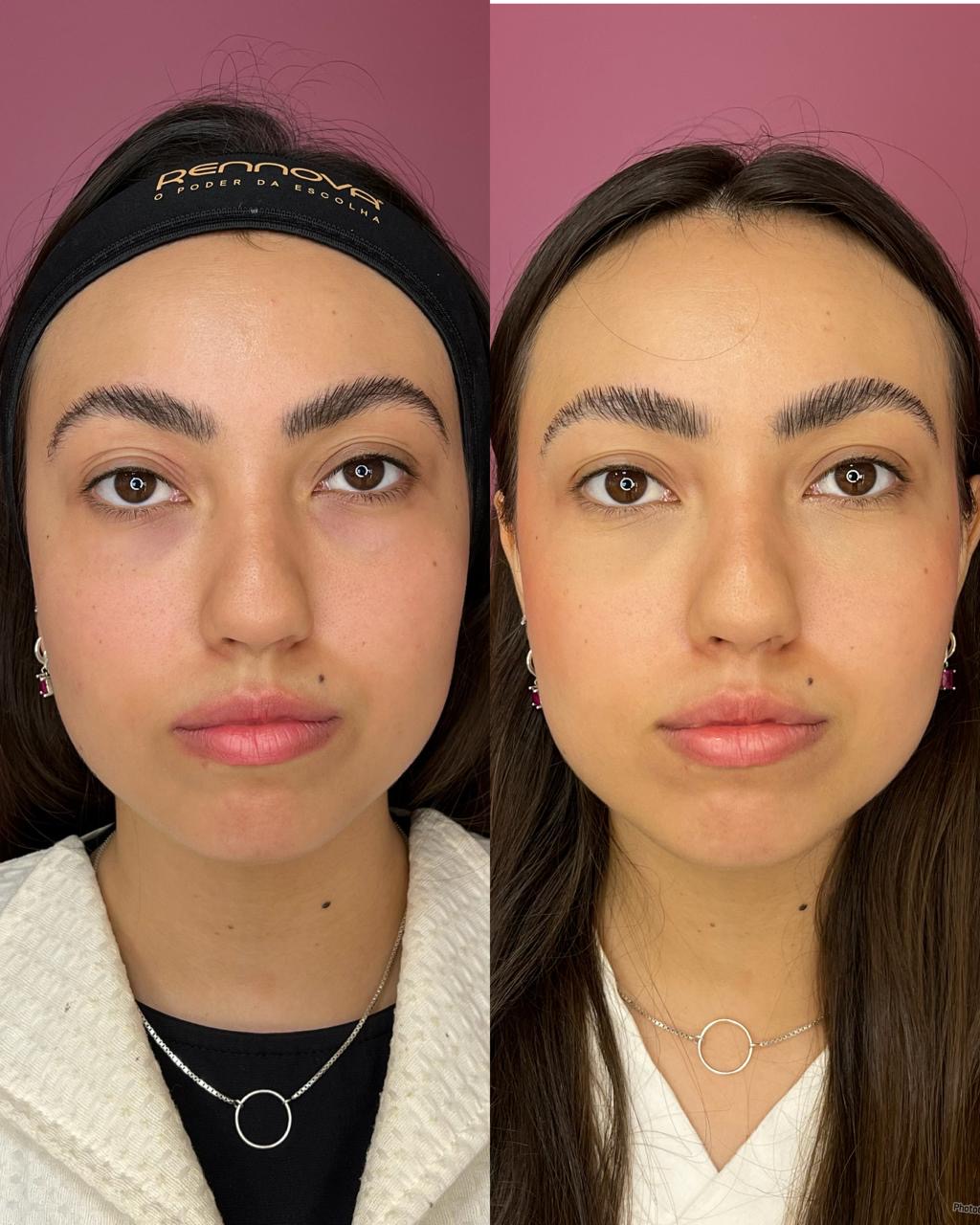 Harmonização facial