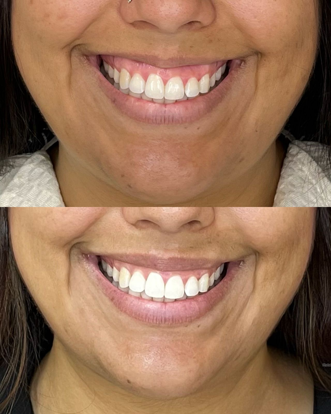 Harmonização facial