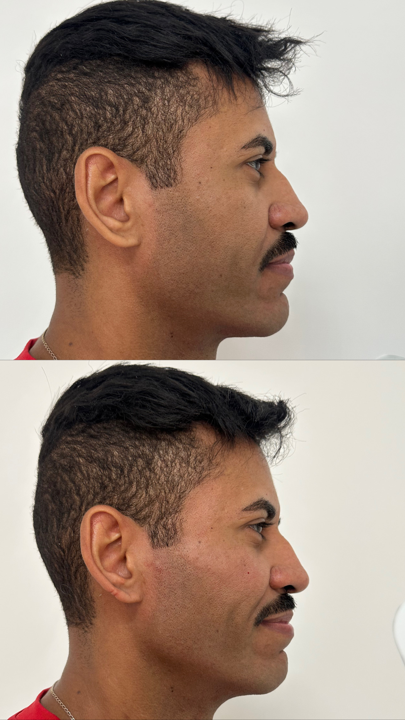 Harmonização facial