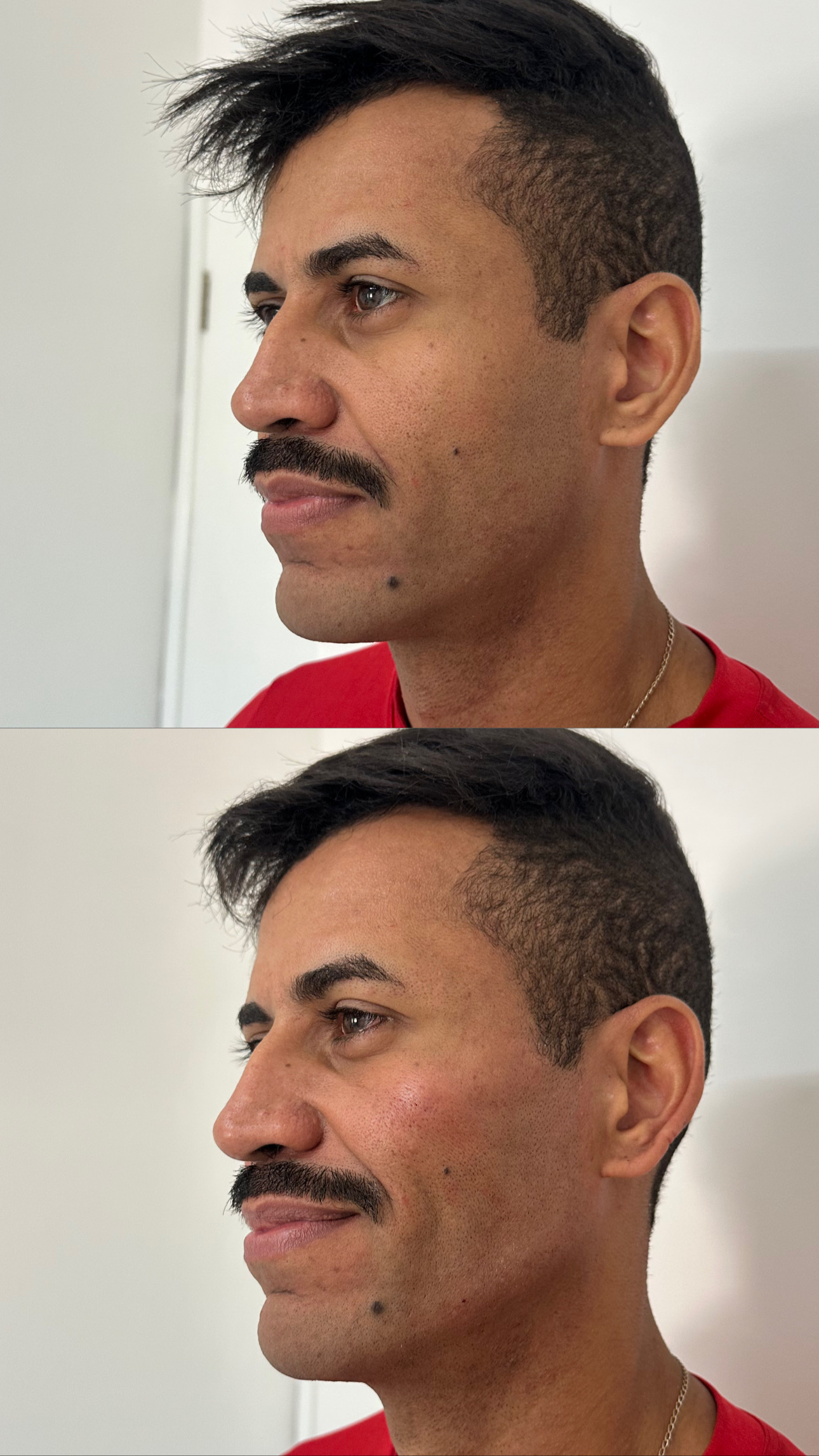 Harmonização facial