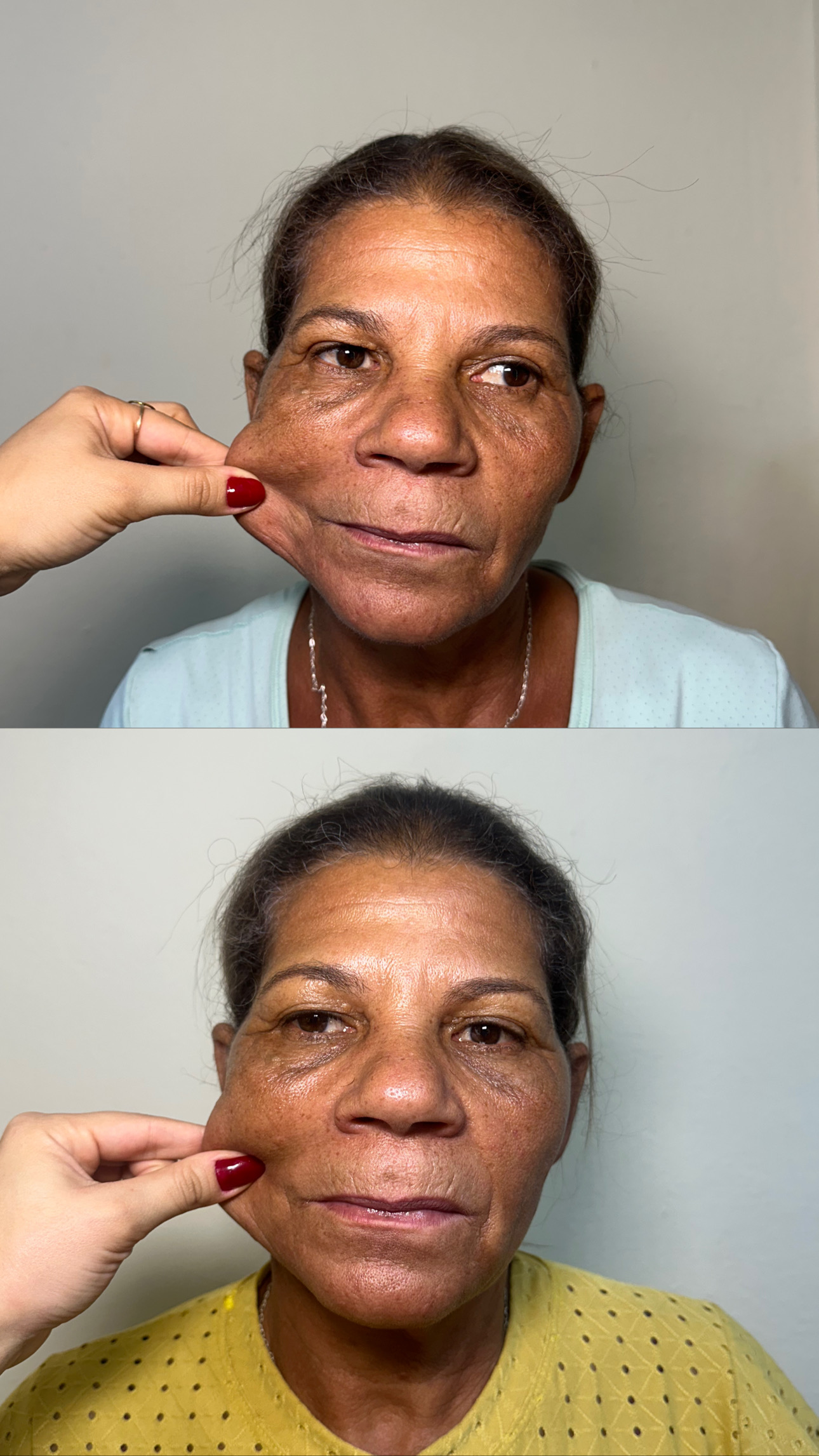 Harmonização facial
