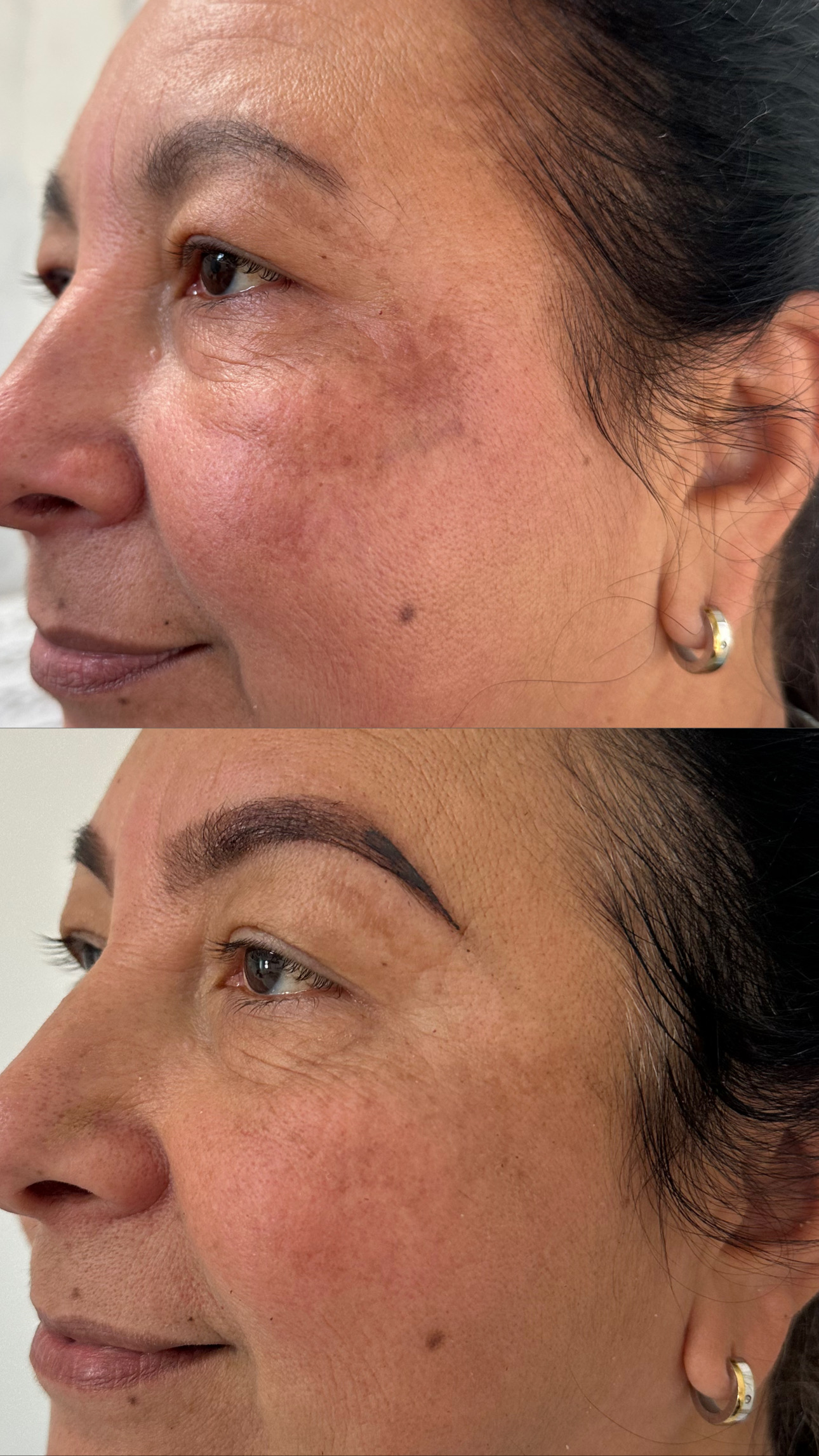 Harmonização facial