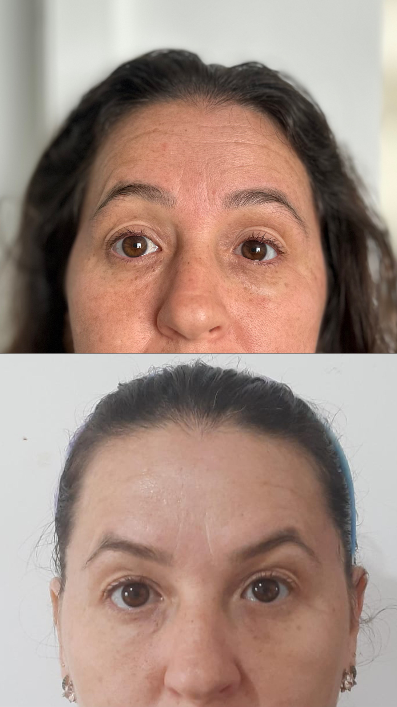 Harmonização facial