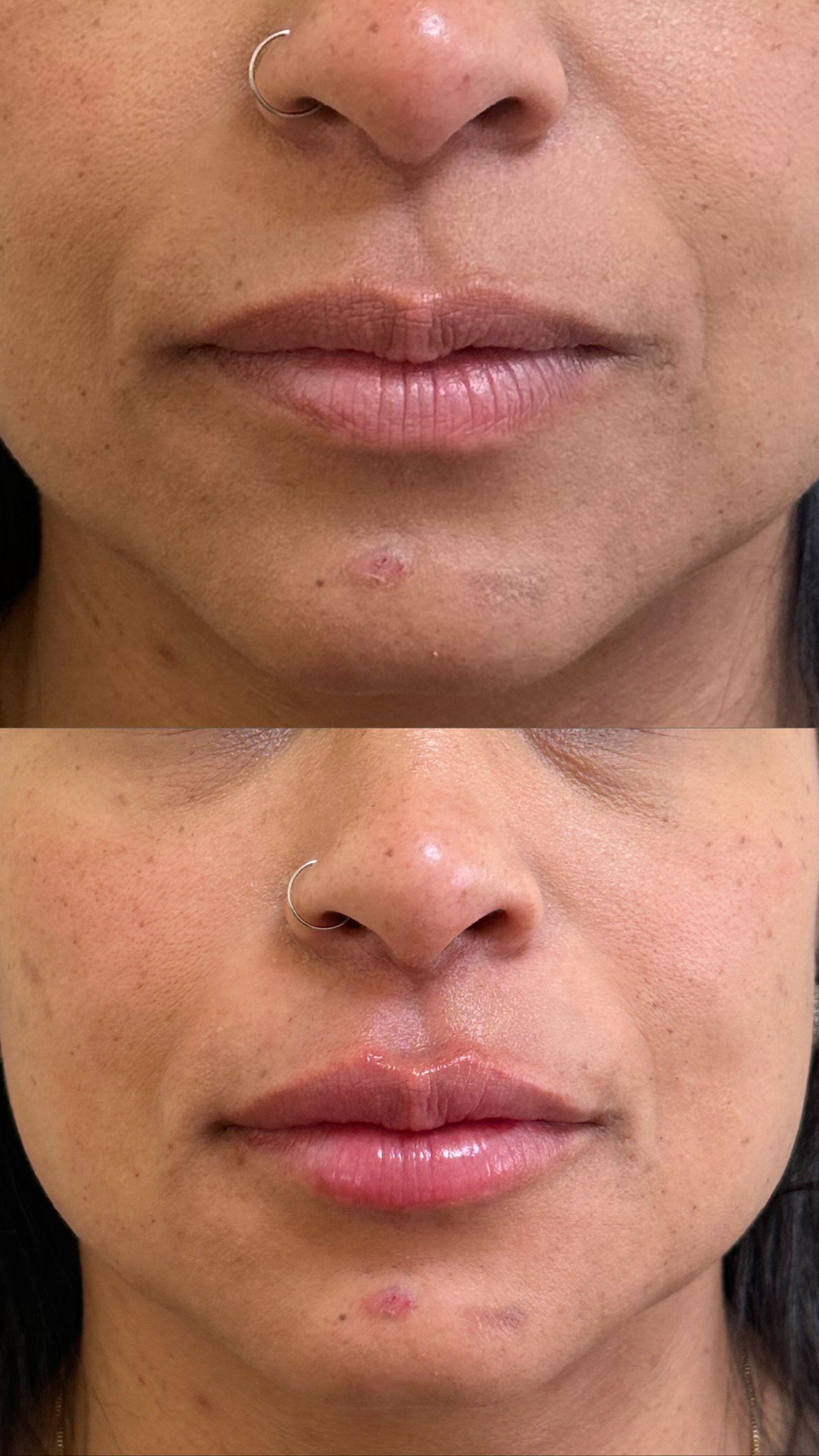 Harmonização facial