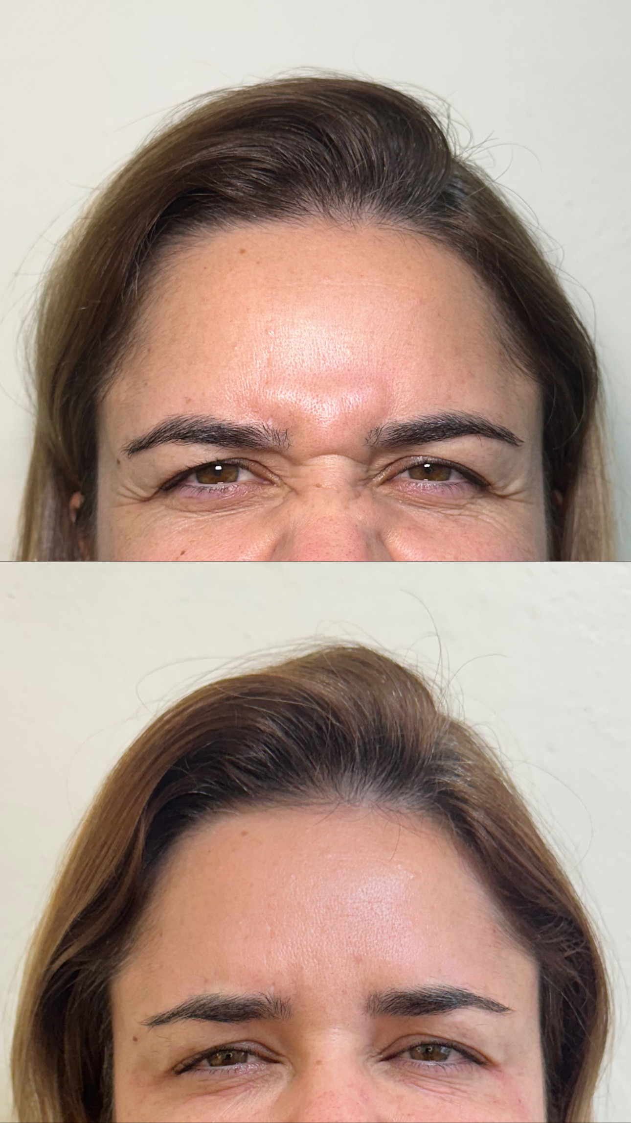 Harmonização facial
